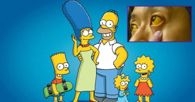 Simpsons Predicted It Again: I Have Acute Jaundice