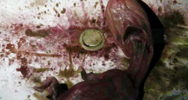 Planned Parenthood Protester’s Sign Just Image of the Sink Baby From P.T.